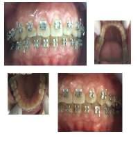 Gingival overgrowth during orthodontic treatment is generally recognized as gingival inflammation caused by the accumulation of plaque and bacteria, also caused by the difficulty of maintaining oral