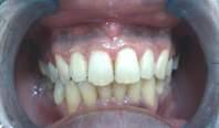 A traditional technique was chosen for gingival depigmentation, using a scalpel. Local anesthetic using infiltration technique with 2% lidocaine was administered.