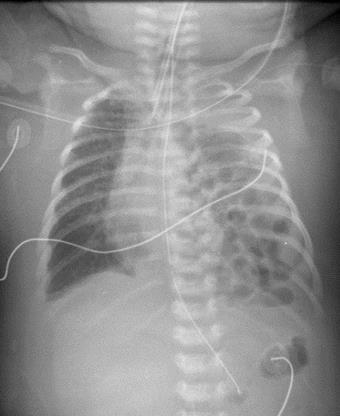 May contain stomach, bowel, liver, or spleen 85-90% occur on left Mediastinal
