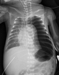 pneumothorax Tension Pneumothorax Accumulation of air in pleural cavity due to