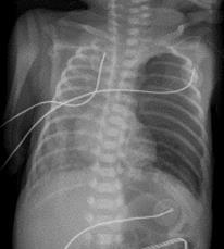 Anterior Pneumothorax Free air is anterior with lucency along cardiac border or diaphragm Usually no