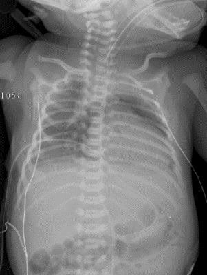 Pneumomediastinum Lucency over upper chest Free air accumulates within mediastinum Air lifts thymus off heart