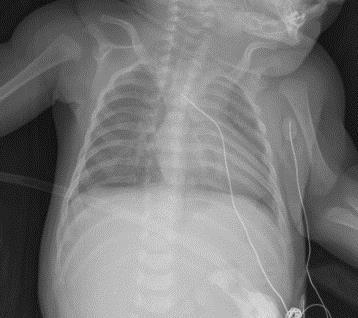 X-rays pass through gas dark shadow Bone and fluid absorbs more x-ray white