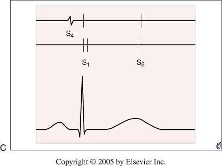 Normal heart sounds First heart sound (S1) Lub Closure of the mitral and tricuspidal valves