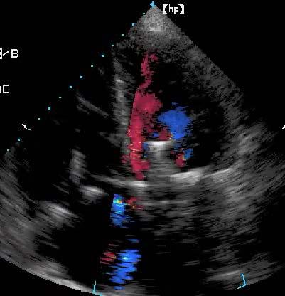7. By color Doppler the degree of mitral regurg in this view is: O a)