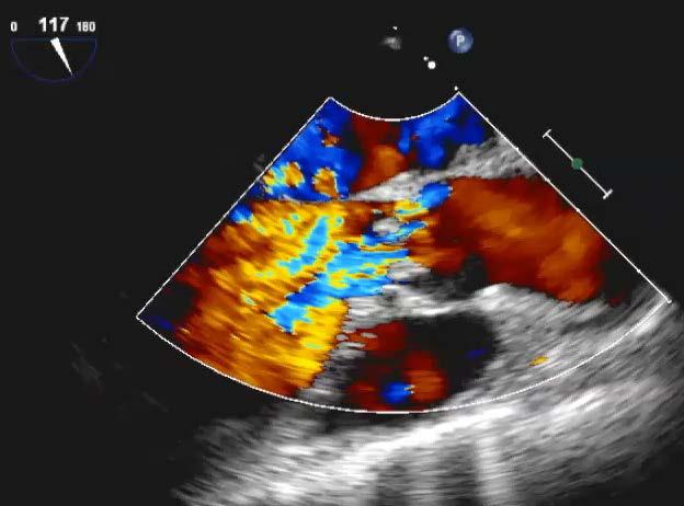 6. This echocardiographic image shows: O a) mitral stenosis O b) aortic