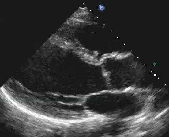 8. This parasternal long-axis image shows: a) possible bicuspid aortic valve O b) classic