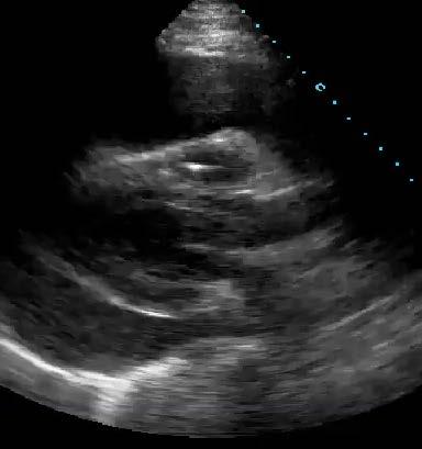 2. Pericardial effusions occur between which two layers?