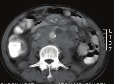 This is because MRI is sensitive to bowel peristalsis and severe motion artifact may obscure the detail within the peritoneal cavity.