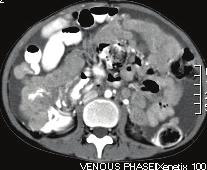 188 THAI J GASTROENTEROL 2016 Axial views of CT scan show multiple lymphadenopathy surrounding the abdominal aorta, giving the appearance of floating aorta sign.