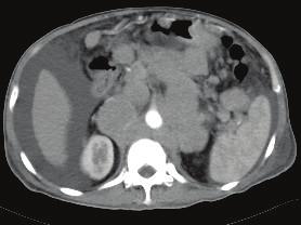 The aorta is lifted above the vertebral body, giving the appearance of the floating aorta sign. The stomach shows irregular thickened wall (arrow). Moderate amount of ascites is noted.