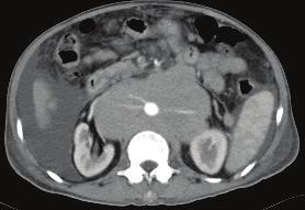 Biopsy of the stomach confirms the diagnosis of lymphoma. Lymphoma can present as nodal or extra-nodal disease. Multiple sites and multiple organs of involvement are hallmark of lymphoma.