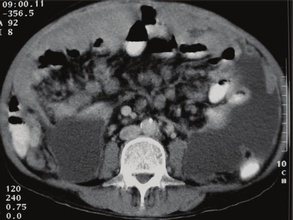 Axial views of CT scan shows marked thickened wall of the stomach (thin arrow) with multiple mesenteric lymphadenopathy.