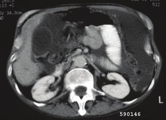 In this case, an irregular gastric mass, associated with lymphadenopathy makes lymphoma, and primary gastric cancer with