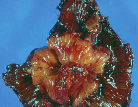 The triad of a calcified mesenteric mass, radiating strands, and adjacent bowel-wall thickening is highly suggestive of carcinoid tumor.