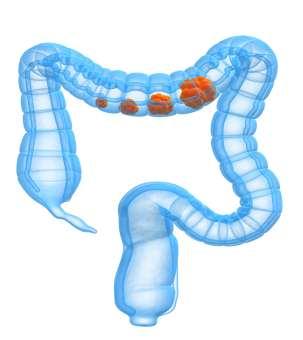 Why is colon cancer the most preventable cancer?