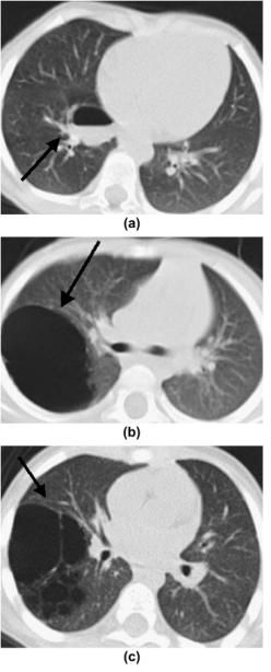 Congenital Cystic Adenomatoid Malformations Bronchial Atresia (a) (b) Unilocular cyst (arrow) with air fluid level in a 5-year-old female patient Unilocular air filled cyst (arrow) causing mass