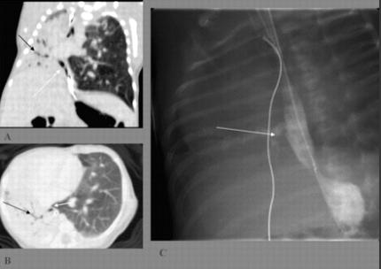 The right lung is small and almost completely opacified, (black arrows). (C) Esophagogram confirms the presence of the esophageal bronchus (arrow).