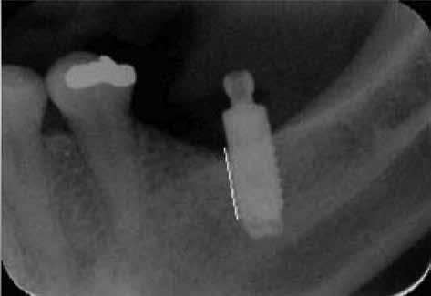 (4) Ahmed Fahmy, et al. C.D.J. Vol. 24. No. (I) months after denture delivery. 1.