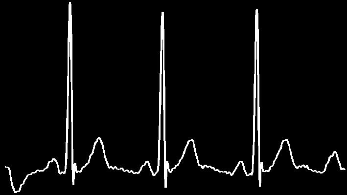 Biomarker extraction Biomarker interpretation Seizure detection: EEG, Ch<1> n-2 n t (sec) EEG, Ch<N> H H BPF1 BPF1 BPF7 BPF7 Σ Σ n-2 n t (sec) ω Arrhythmia detection: Σ Σ ω Energy extracted every