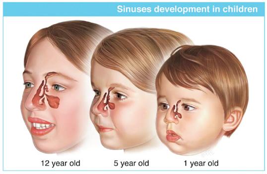 Sinus development Born with ME ( Maxillary, Ethomoid)