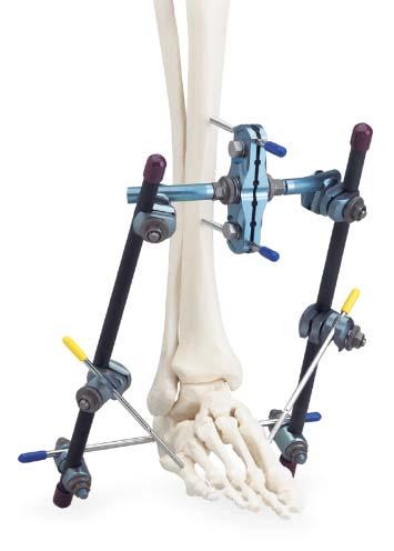 Optional Frame Configurations continued Enhancing the frame for additional stability To prevent equinus contracture, several options are available. A 4.