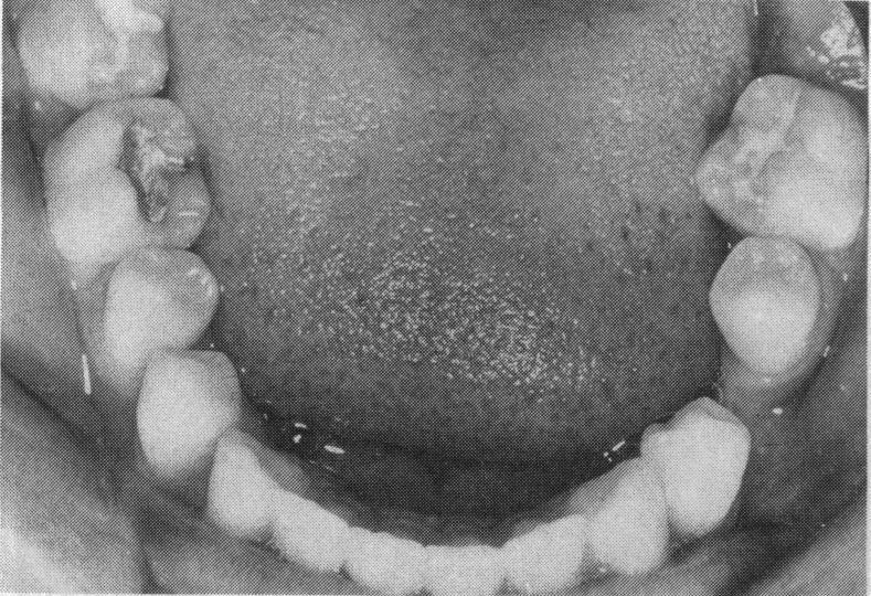 Occlusal view of upper arch of patient in Figure 12 showing fissure sealant in place Figure 11.