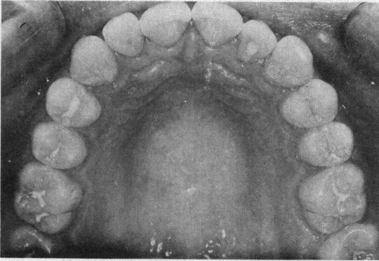 Which arch will require further dental attention in future years? How often will those amalgams be replaced and extended in the next 50 years?