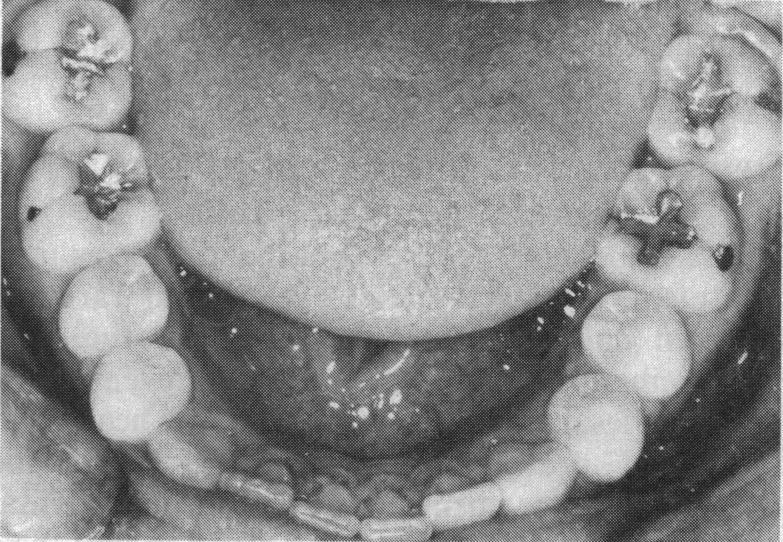 The bitewings (Figure 15) certainly suggest that some of the occlusal amalgams are minimal and might have been obviated by a more preventive approach.