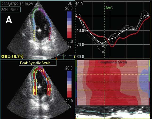 Despite promising data, quantitative assessment of the magnitude of regional LV deformation cannot be recommended
