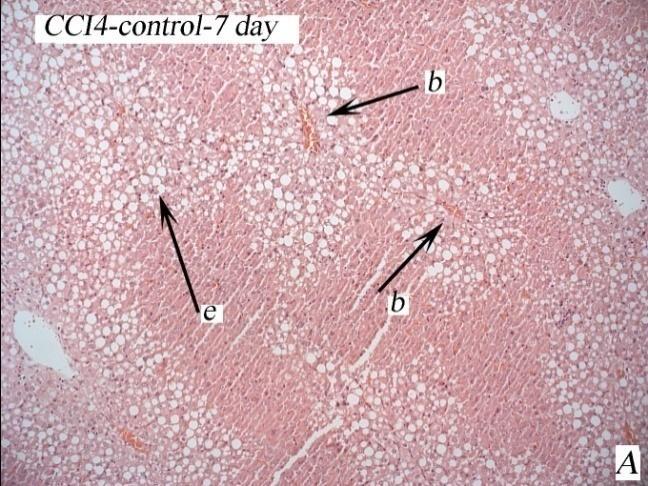 Issues Biol. Sci. Pharma. Res. 4 Figure 5: CCI4 induced liver damage histopathology in 7 days. (A-Control-H&Ex1; B-, H&Ex2) b. vein, c. liver triads, d. inflammatory cell infiltration. e.