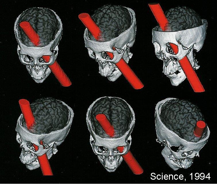Brain injuries The Story of Phineas Gage Because