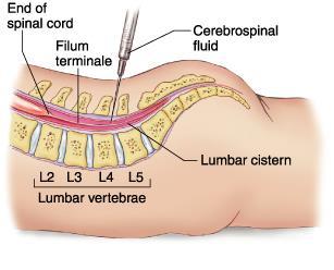 12. Cerebrospinal Fluid (CSF) - fluid that protects and supports brain Lumbar puncture (spinal tap) is performed in your lower back, in the lumbar region.