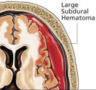 Subdural Hematoma a type of hematoma,