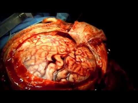 Natgeo Brain Surgery Video -