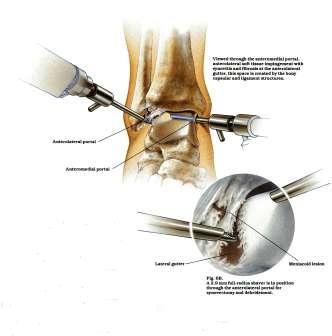 the anterior-lateral aspect of the ankle joint.