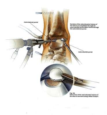 Examination of the Joint Successful arthroscopic examination of the ankle, like that of the knee or shoulder, requires a methodical approach.