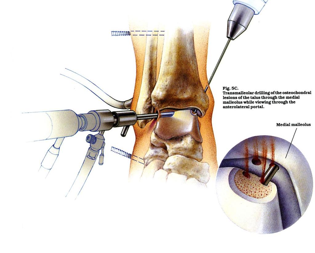 fluoroscopic control, to stimulate a new blood supply and healing, can be performed through the arthroscope.