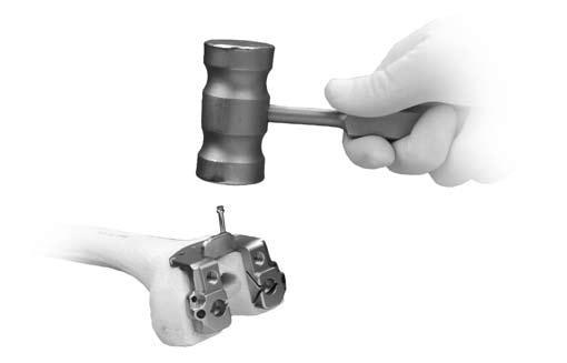 6k Insert two short headed pins or short screws through the anterior flange Knee in 90 flexion Secure the MIS Notch/Chamfer Guide to the femur distally with two Short Spring Screws or 3.