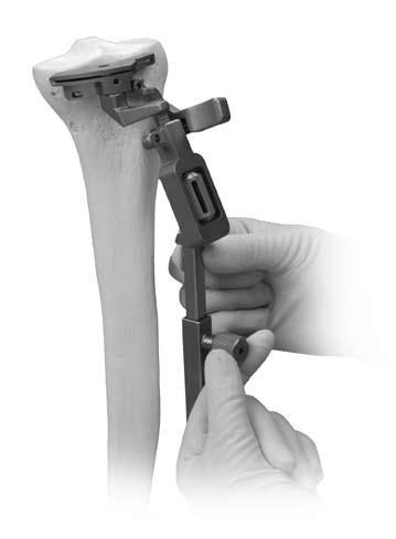 Zimmer MIS Intramedullary Instrumentation Surgical Technique 25 Position the Guide Place the spring arms of the Ankle Clamp around the ankle proximal to the malleoli and loosen the anterior knob that