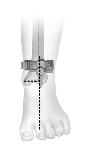 Loosen the knob on the proximal end of the Distal Telescoping Rod and adjust the length of the guide until the Tibial Cut Guide is positioned at the approximate depth of cut.