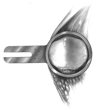 Check to be sure that the 10mm gauge does not rotate beneath the anterior surface of the patella.