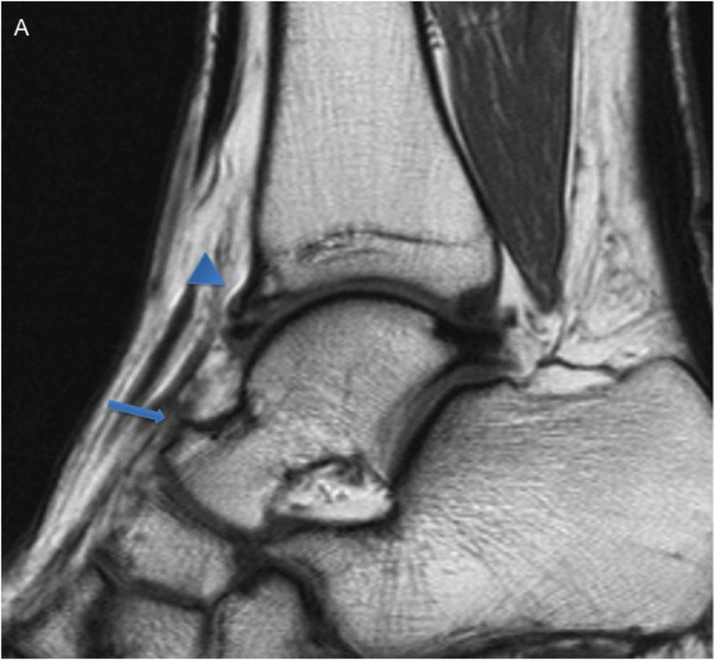 Fig. 2: 34-year-old woman with anterolateral impingement. Axial T2-weighted image shows low-signal-intensity thickened anterior talofibular ligament (arrow) in the lateral gutter. Fig.