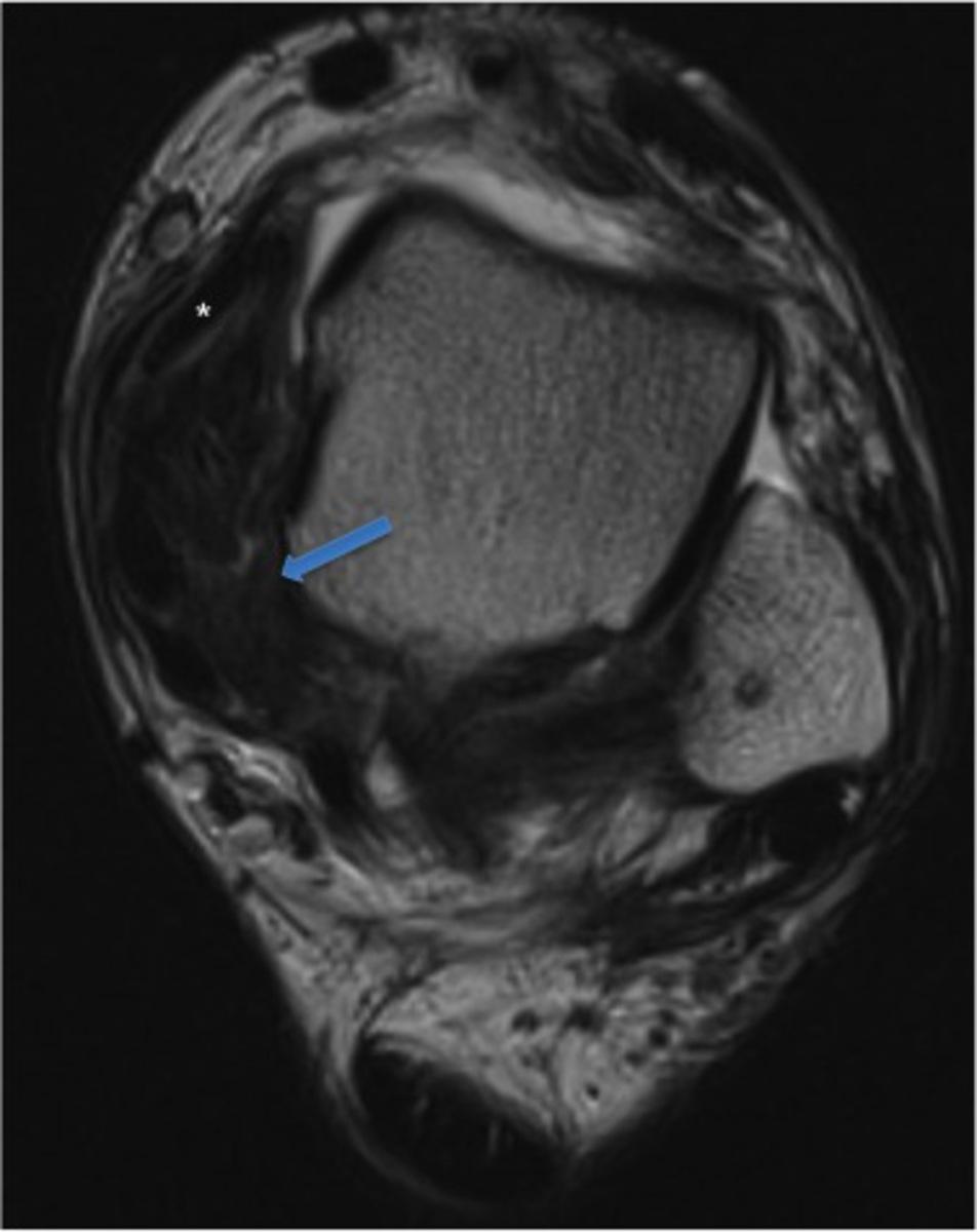 Fig. 9: 43-year-old man with anteromedial and posteromedial impingement.