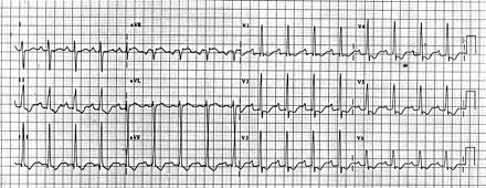 ECG Findings Electrocardiogram demonstrating the changes of right ventricular hypertrophy for example,