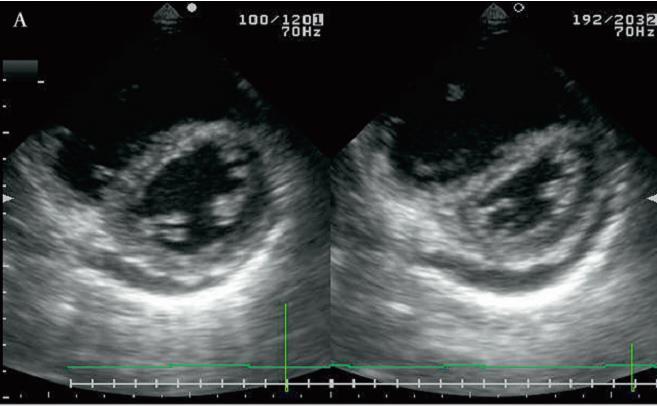 Echocardiographic findings in a patient with pulmonary