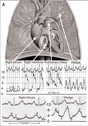 Standard right-heart catheterization measurements include: right atrial pressure (RAP) right ventricular pressure (RVP) pulmonary arterial pressure (PAP) pulmonary capillary wedge pressure (PCWP)