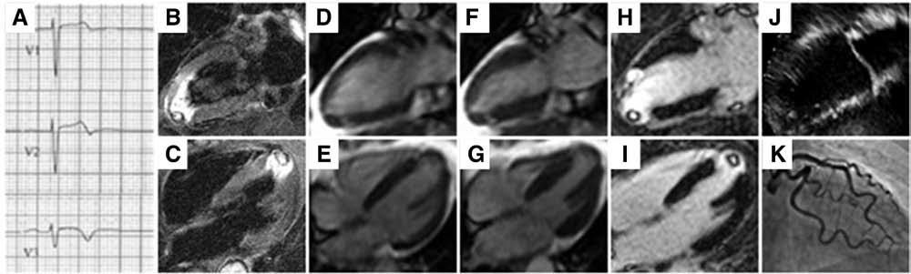 B, Resting first-pass perfusion shows a region of MVO in the subendocardial region at the infarct core that closely correlates with the early gadolinium-enhanced images (C).