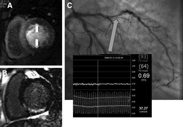 MRI Coron &FFR ACS Complications CMR images from a patient with previous stents in the right coronary arteryand left anterior descending coronary artery 2 years earlier who presented to the emergency