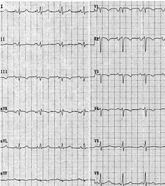 I- Abnormalities of ECG Waves and Segments P Wave Abnormalities: left Atrial